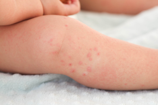 Rash